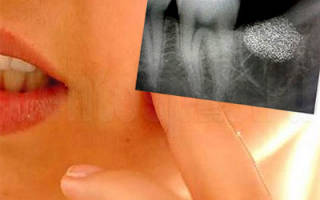Осложнения при удалении зуба