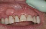 Уплотнение после удаления зуба
