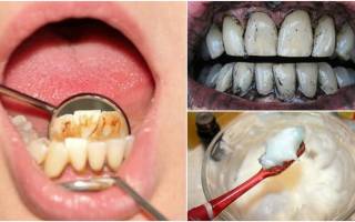 Как лечить зубной камень в домашних условиях