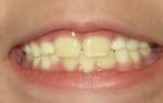 Почему у ребенка желтые зубы