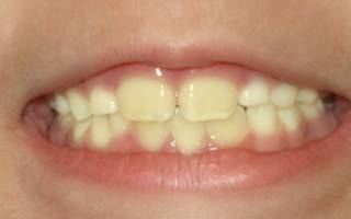 Желтые зубы у ребенка причины