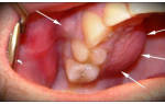 Опухоль десны после удаления зуба