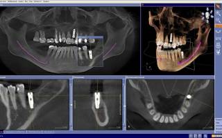 Компьютерная томография зуба