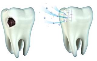 Капы для реминерализации зубов