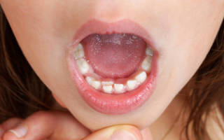 Зуб вырос вторым рядом у ребенка
