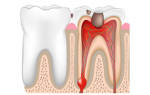 Воспаление на корне зуба лечение