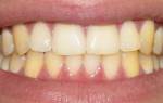 Почему зубы желтые