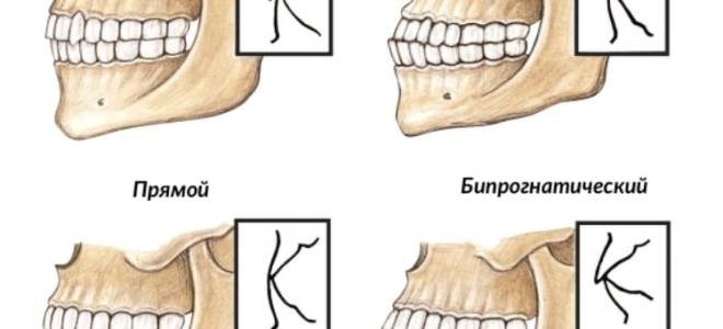 Что такое прикус зубов