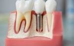 Зубные имплантанты за и против