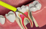 Болит зуб после депульпации