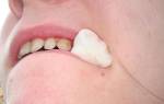 Почему после удаления зуба нельзя полоскать рот