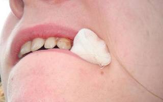 Почему после удаления зуба нельзя полоскать рот