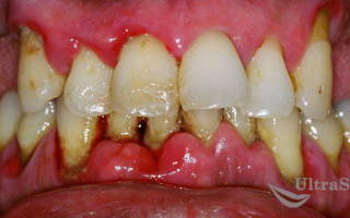 Чистка десен в стоматологии