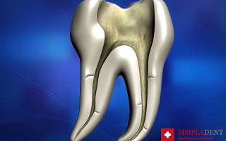 Корневой канал зуба