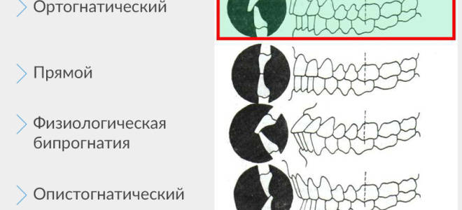 Прикус зубов правильный и неправильный