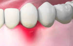 Чем лечить воспаление десны вокруг зуба