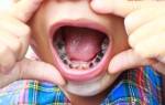 Гниют молочные зубы у ребенка