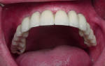 Сколько каналов у зуба