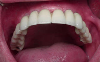 Сколько каналов в 7 верхнем зубе