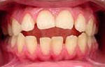 Ортодонтия открытый прикус