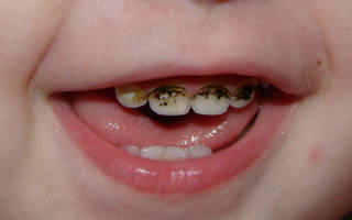 Что такое серебрение зубов