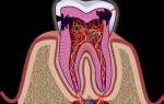 Воспаление зубного нерва лечение