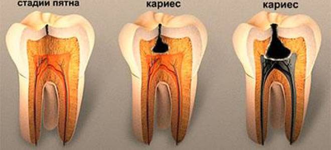 Кариес или пульпит как определить