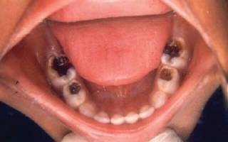 Пульпит молочных зубов у детей