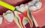 После лечения кариеса болит зуб при надкусывании