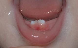 Кривые молочные зубы у ребенка