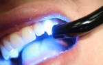 Световые пломбы на передних зубах