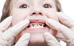 Почему чернеют зубы у ребенка