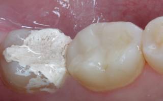 Должен ли болеть зуб с мышьяком