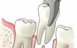 Сколько болит вырванный зуб