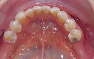 Надо ли лечить кариес молочных зубов