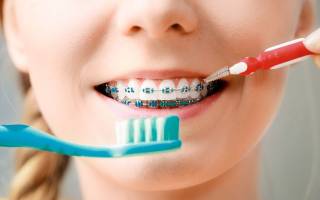 Как чистить зубы с брекетами зубной щеткой