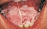 Как лечить лейкоплакию полости рта