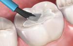 Герметизация фиссур постоянных зубов