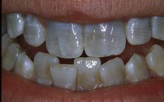 Как удалить коричневый налет на зубах