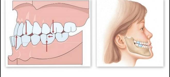 Мезиальный прикус у ребенка