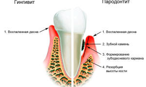 Воспаление в десне под зубом