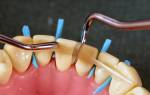 Что такое шинирование зубов
