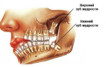 Удаление 8 зуба сверху