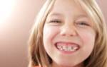 Зубные пластины для выравнивания зубов