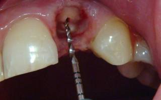 Корень зуба остался в десне последствия