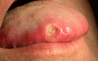 Воспаление языка по бокам
