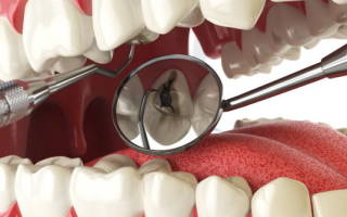 Как болит зуб при пульпите