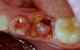 Гниет корень зуба симптомы