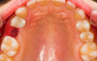 Болит зуб мудрости симптомы