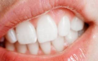 Десны отходят от зубов лечение
